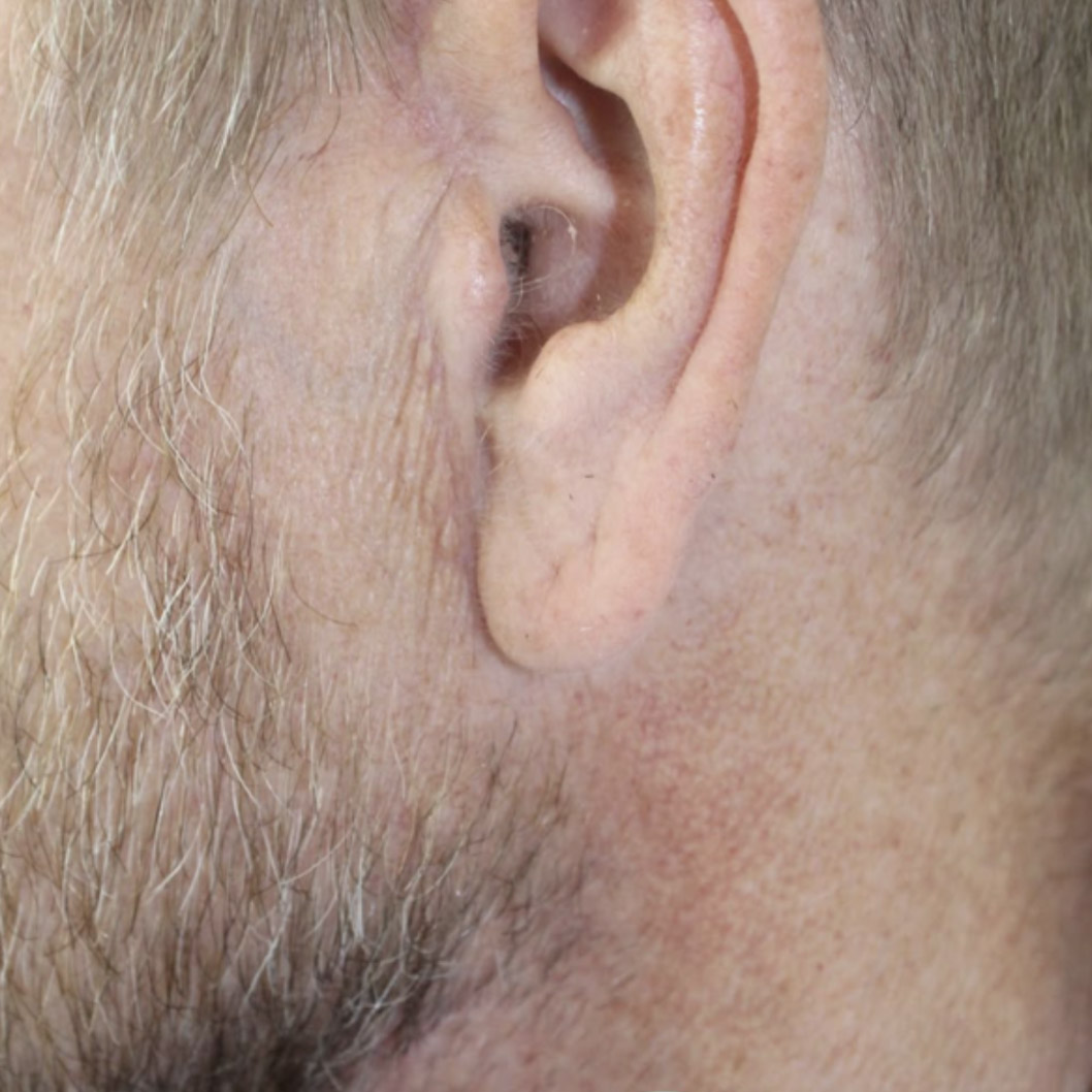 Jaw joint (TMJ) surgery