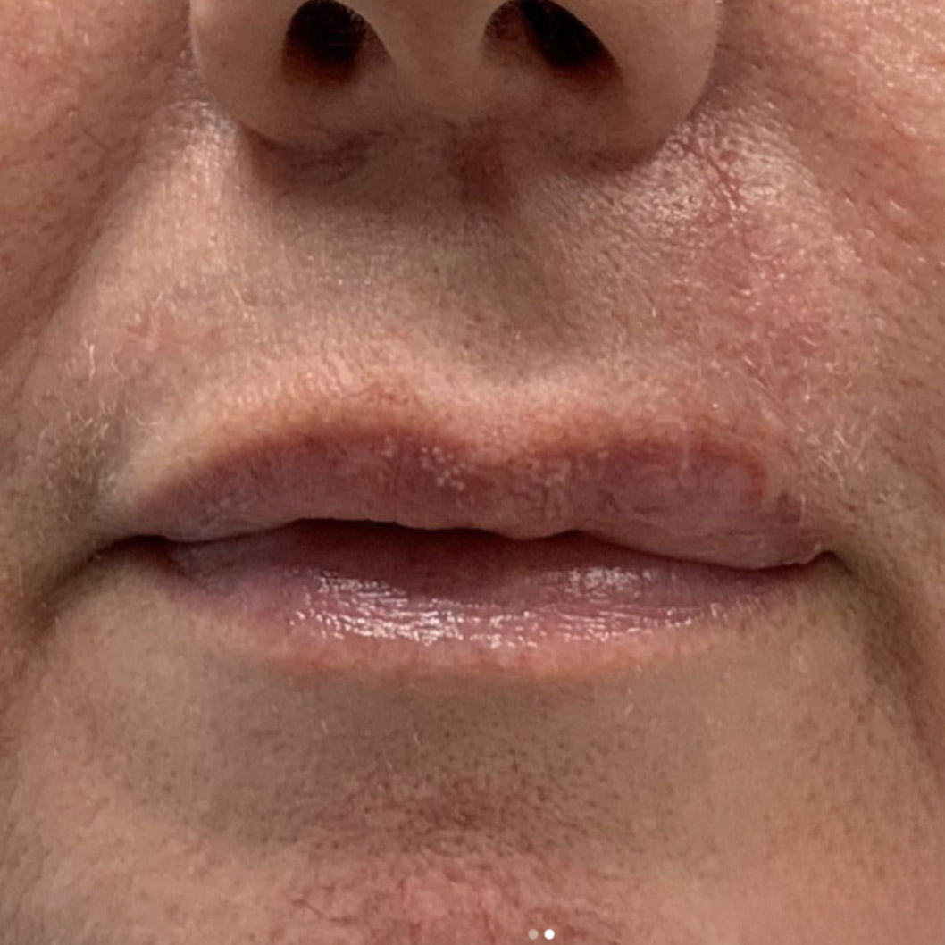 Skin cancer surgery