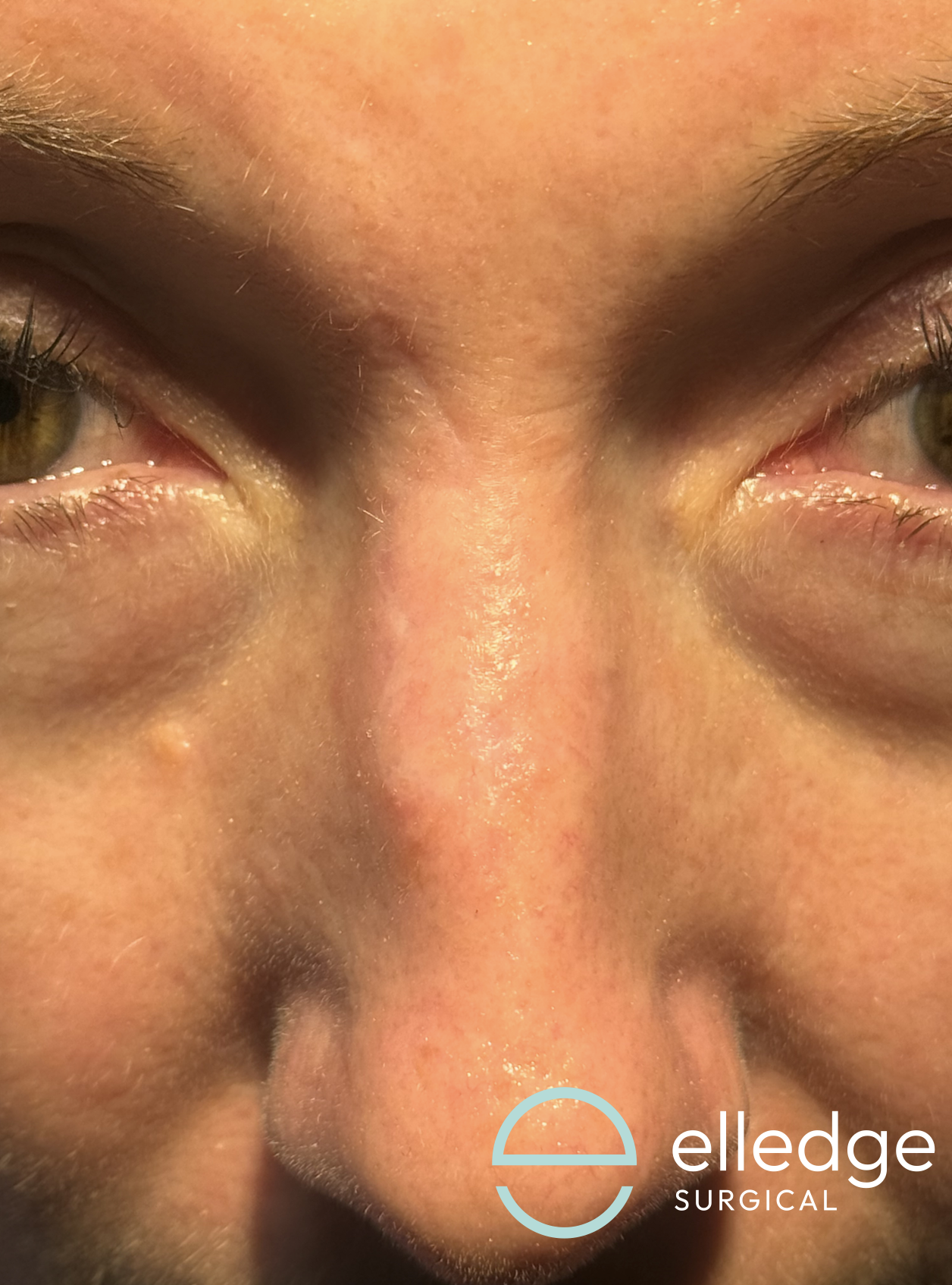 This image shows the healed appearance of a patient's nose following excision of a skin cancer and reconstruction with little in the way of visible scarring.
