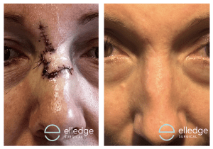 Comparative pictures of a patient following removal of a skin cancer from the nose and reconstruction with a local flap