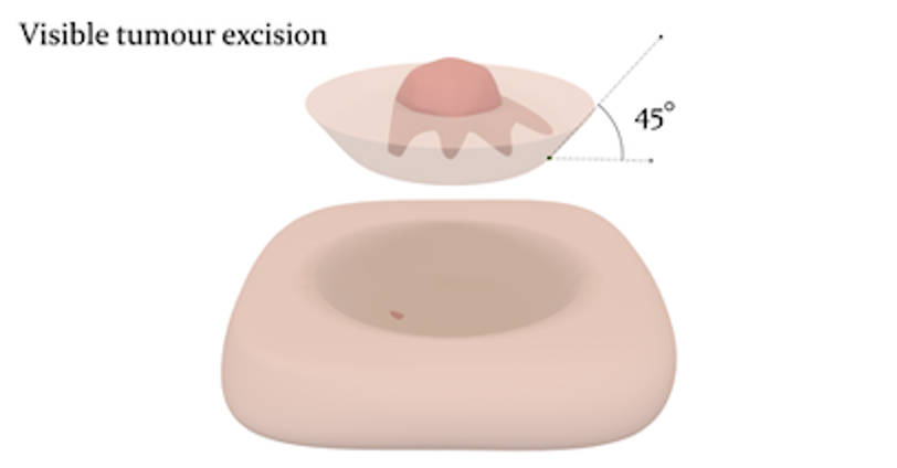 The initial stage of Mohs micrographic surgery