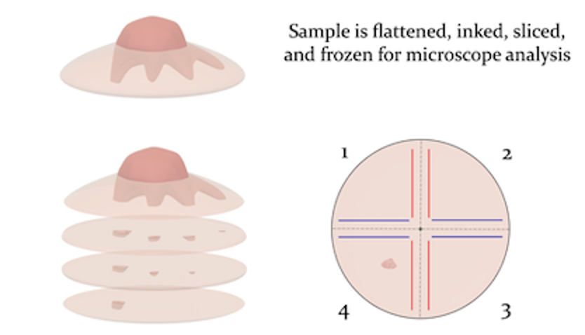 Second stage Mohs micrographic surgery