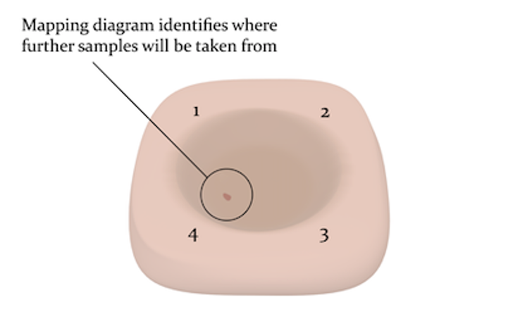 Further stages Mohs micrographic surgery