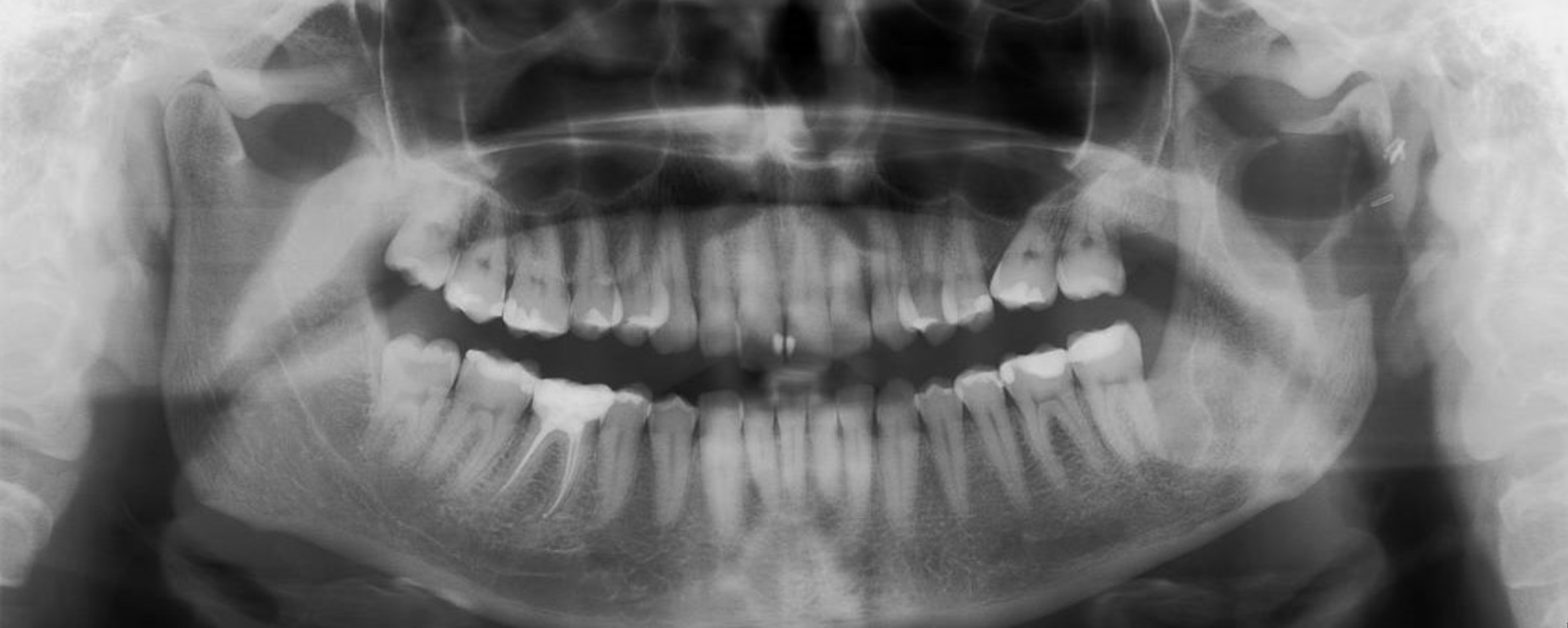 Pathological fracture of the mandible