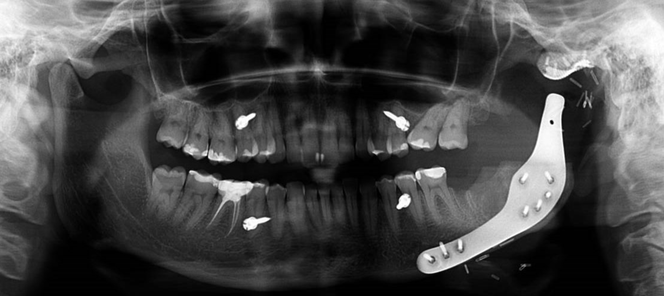 Extended temporomandibular joint replacement