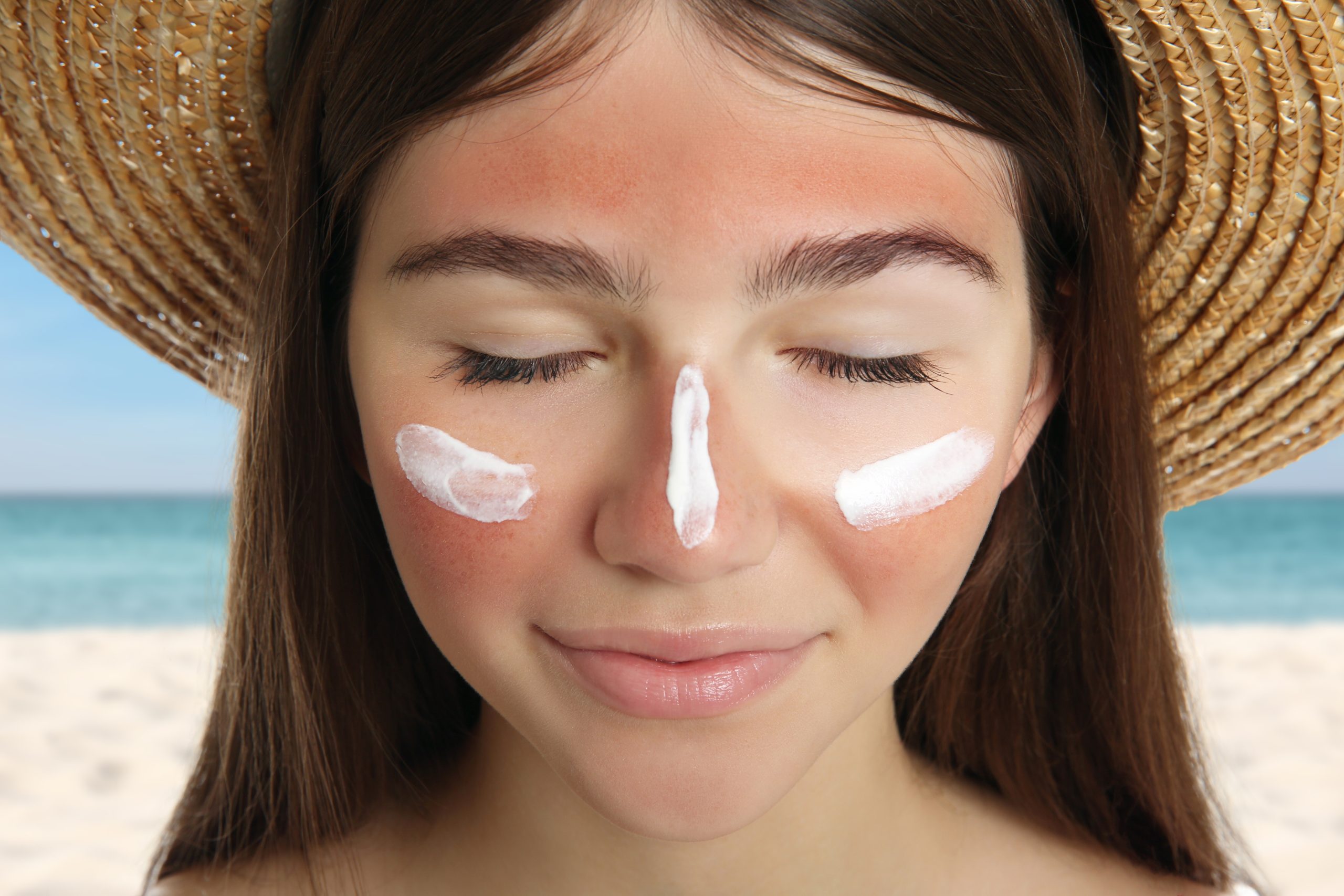 girls with sunburned skin on face with soothing cream