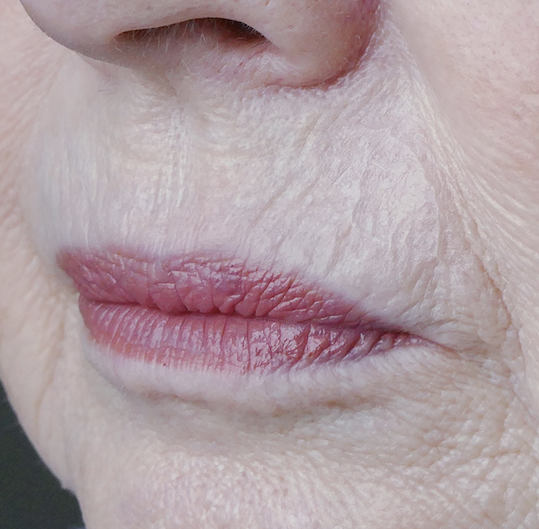 Healing of the upper lip following island flap repair