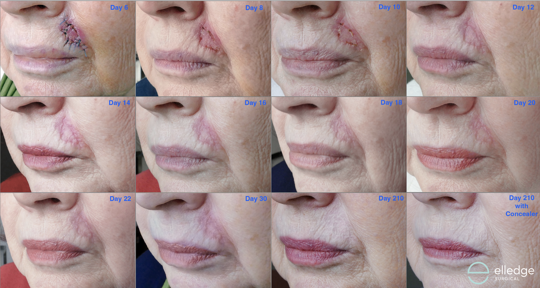 A series of images demonstrating healing from an island flap repair.